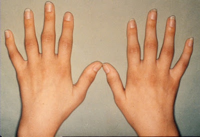 rheumatoid-arthritis_2