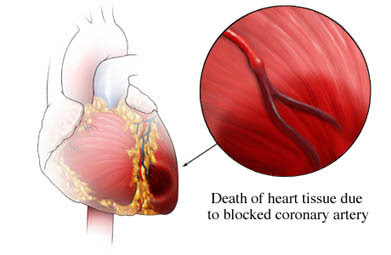 heart-attack