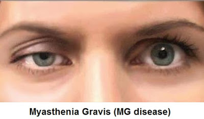 myasthenia-gravis-mg-disease