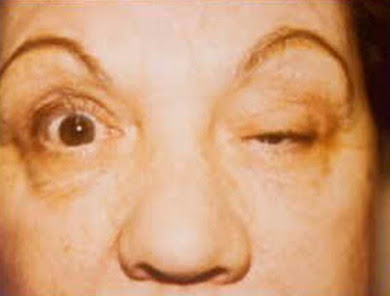 myasthenia-gravis
