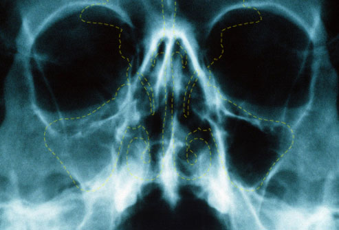 PRinc_rm_x-ray_of_acute_sinusitis