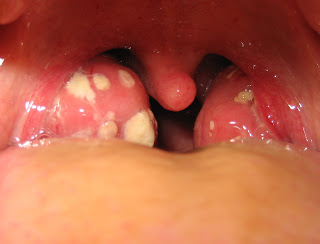 Tonsillitis