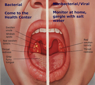 tonsillitis-1914