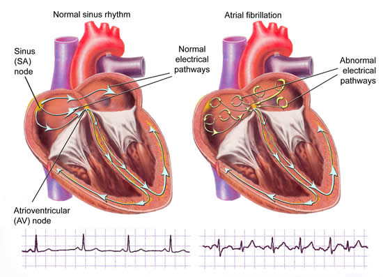 atrial-fibrillation