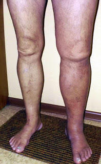 deep-venous-thrombosis-(DVT)