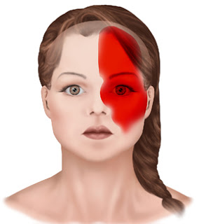 migraine-rich-hirschinger-beverly-hills-headache