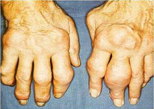 oyrikh_arthritis1