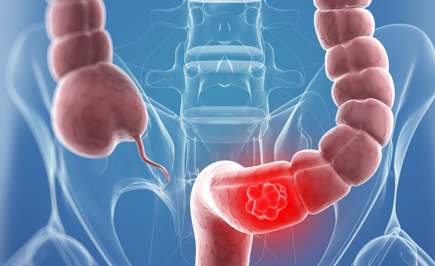 Natural News : Η απλή αλλαγή της διατροφής σας μπορεί να συρρικνώσει τους όγκους του καρκίνου του παχέος εντέρου, σύμφωνα με μελέτη