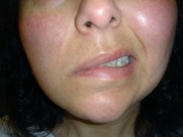 bells-palsy-pictures-2