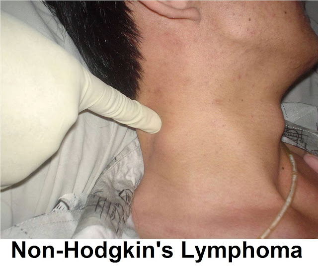 Τι είναι το λέμφωμα Hodgkin; Kαρκίνος στο λεμφικό σύστημα. Ποιες οι διαφορές από το μη Hodgkin’s;