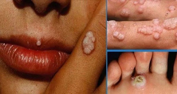 Κονδυλώματα, μυρμηγκιές, Human Papilloma Virus HPV. Τρόπος μετάδοσης; Εμβολιασμός και πρόληψη