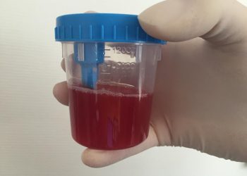 Αιματουρία. Σοβαρές και απειλητικές για τη ζωή αιτίες που υπάρχει αίμα στα ούρα;