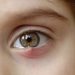 Χαλάζιο στο μάτι. Ποια η διαφορά με το κριθαράκι; Πώς θεραπεύεται και αποτρέπεται η υποτροπή;