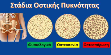 D3 & K2 ΠΡΟΛΗΨΗ ΓΙΑ ΟΣΤΕΟΠΕΝΙΑ & ΟΣΤΕΟΠΟΡΩΣΗ