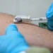 Γερμανός λοιμωξιολόγος για την Ευλογιά των Πιθήκων: Στείλτε όλα τα εμβόλια στην Αφρική
