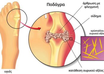 Ουρικό οξύ και φυσική αντιμετώπιση