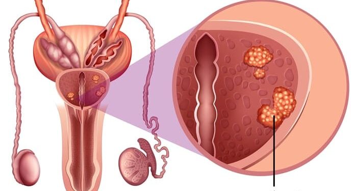 Η Σιωπηλή Απειλή – Ο Dr. Jiri Kubes Προειδοποιεί για τον Καρκίνο του Προστάτη. Όταν η πρόληψη καθυστερεί, το κόστος είναι ανθρώπινο και εθνικό.