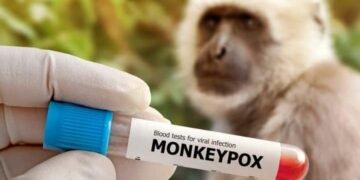 Το πρώτο κρούσμα Ευλογιάς των Πιθήκων στην Ελλάδα το 2026 στα  Ιωάννινα!