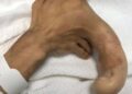 Το σύνδρομο Proteus είναι τόσο σπάνιο που λιγότεροι από 500 άνθρωποι στη Γη είναι γνωστό ότι το έχουν.