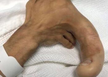 Το σύνδρομο Proteus είναι τόσο σπάνιο που λιγότεροι από 500 άνθρωποι στη Γη είναι γνωστό ότι το έχουν.